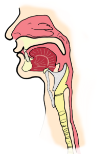 subglottic stenosis